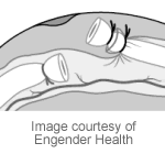 fascial-interposition-vas-deferens