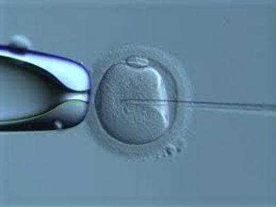 Sperm count after reverse vasctomy