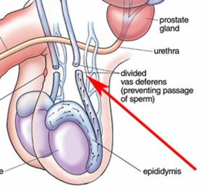 vasectomy-decreases-sperm-in-semen