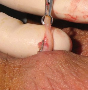 clip-vasectomy-clip-across-upper-end