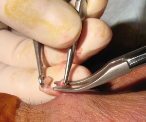 vasectomy-clip-application