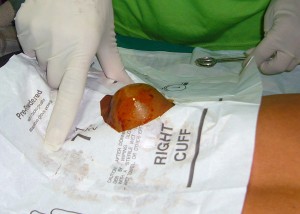 Back-tumor-prepped-for-removal