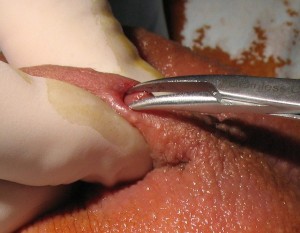 No-scalpel-vasectomy-dissector