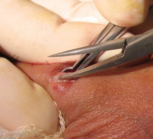 dissecting-the-vas-deferens  